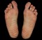 ganglion cyst foot