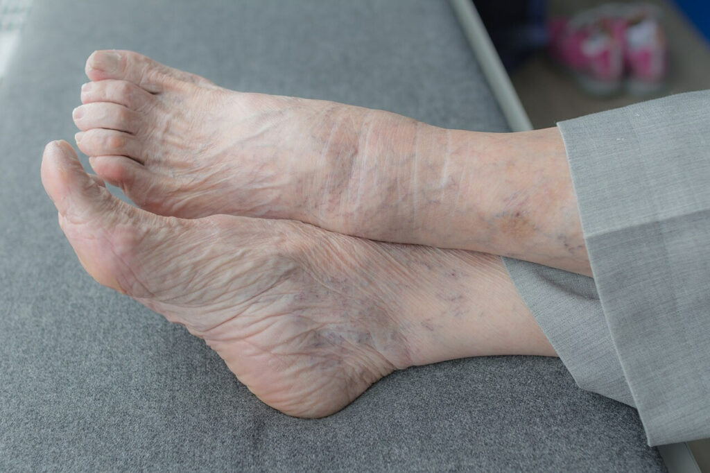What are the Most Common Foot Problems for the Elderly? 