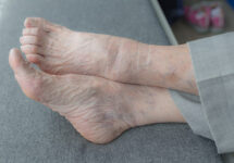 What are the Most Common Foot Problems for the Elderly? 